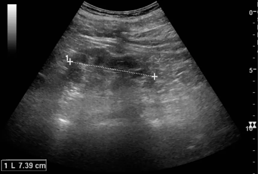 Kidney Classification